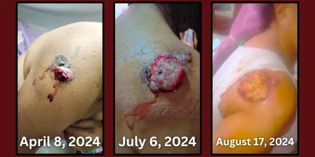 mama carcinoma on the back growing from july to august